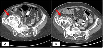 Case report: prolonged durable clinical benefit and low toxicity from combination endocrine therapy in a patient with recurrent endometrial carcinoma